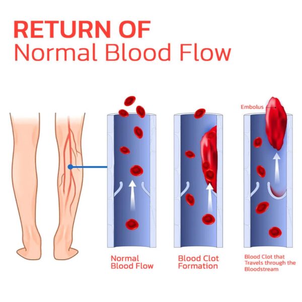Arch Support, Anti-slip And Wear-resistant Body Care, Slimming And Body Shaping, Vein Repair Insoles - Image 3