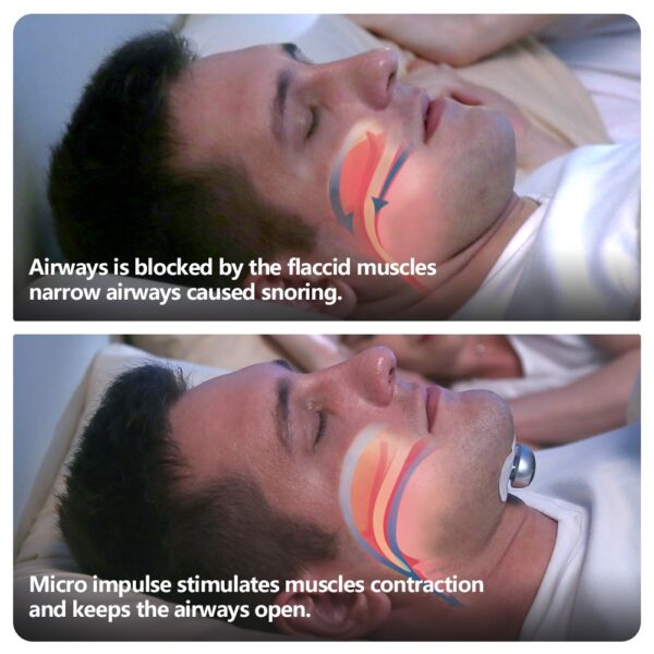 Smart Anti Snoring Device Electronic Muscle Stimulator Pro - Image 2