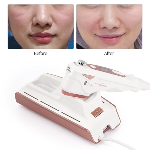 Home V Face Lifting Ultrasonic Knife Lifting Anti-aging Beauty Instrument - Image 4