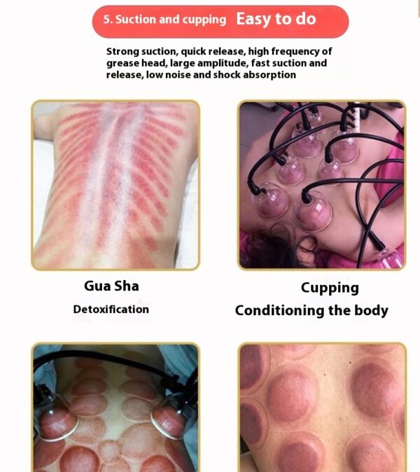 Internal Negative Pressure Health Care Scraping Cupping Electric Physiotherapy Instrument - Image 8