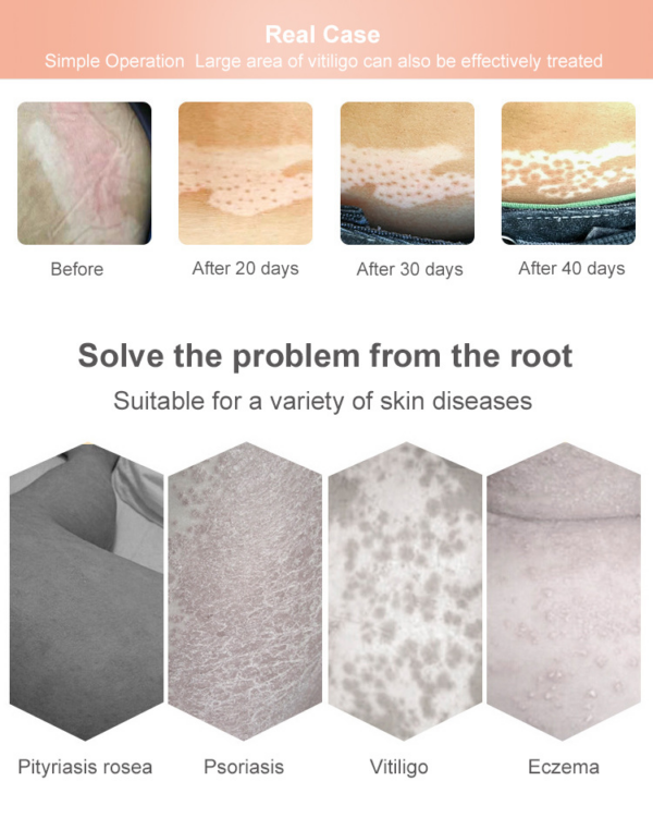 Phototherap UVB Phototherapy Instrument Ultraviolet-Lamp Home Vitiligo Psoriasis Treatment Laser - Image 10