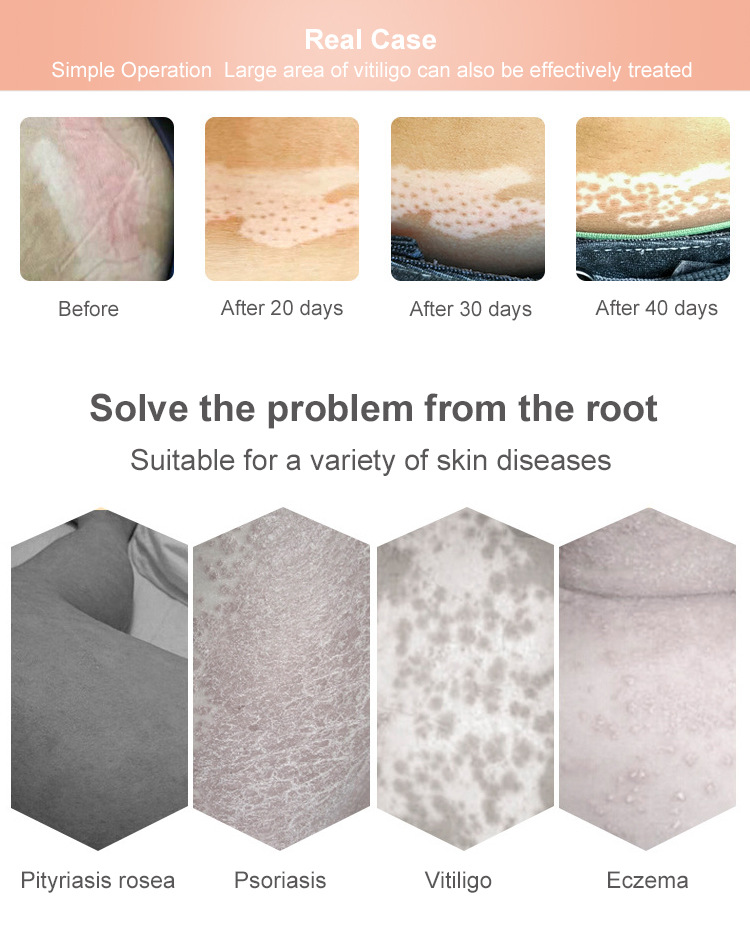 Phototherap UVB Phototherapy Instrument Ultraviolet-Lamp Home Vitiligo Psoriasis Treatment Laser - Image 10